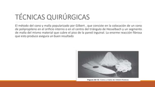 TÉCNICAS QUIRÚRGICAS
El método del cono y malla popularizado por Gilbert , que consiste en la colocación de un cono
de polipropileno en el orificio interno o en el centro del triángulo de Hesselbach y un segmento
de malla del mismo material que cubre el piso de la pared inguinal. La enorme reacción fibrosa
que esto produce asegura un buen resultado
 