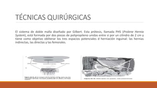 TÉCNICAS QUIRÚRGICAS
El sistema de doble malla diseñado por Gilbert. Esta prótesis, llamada PHS (Prolene Hernia
System), está formada por dos piezas de polipropileno unidas entre sí por un cilindro de 2 cm y
tiene como objetivo obliterar los tres espacios potenciales d herniación inguinal: las hernias
indirectas, las directas y las femorales.
 