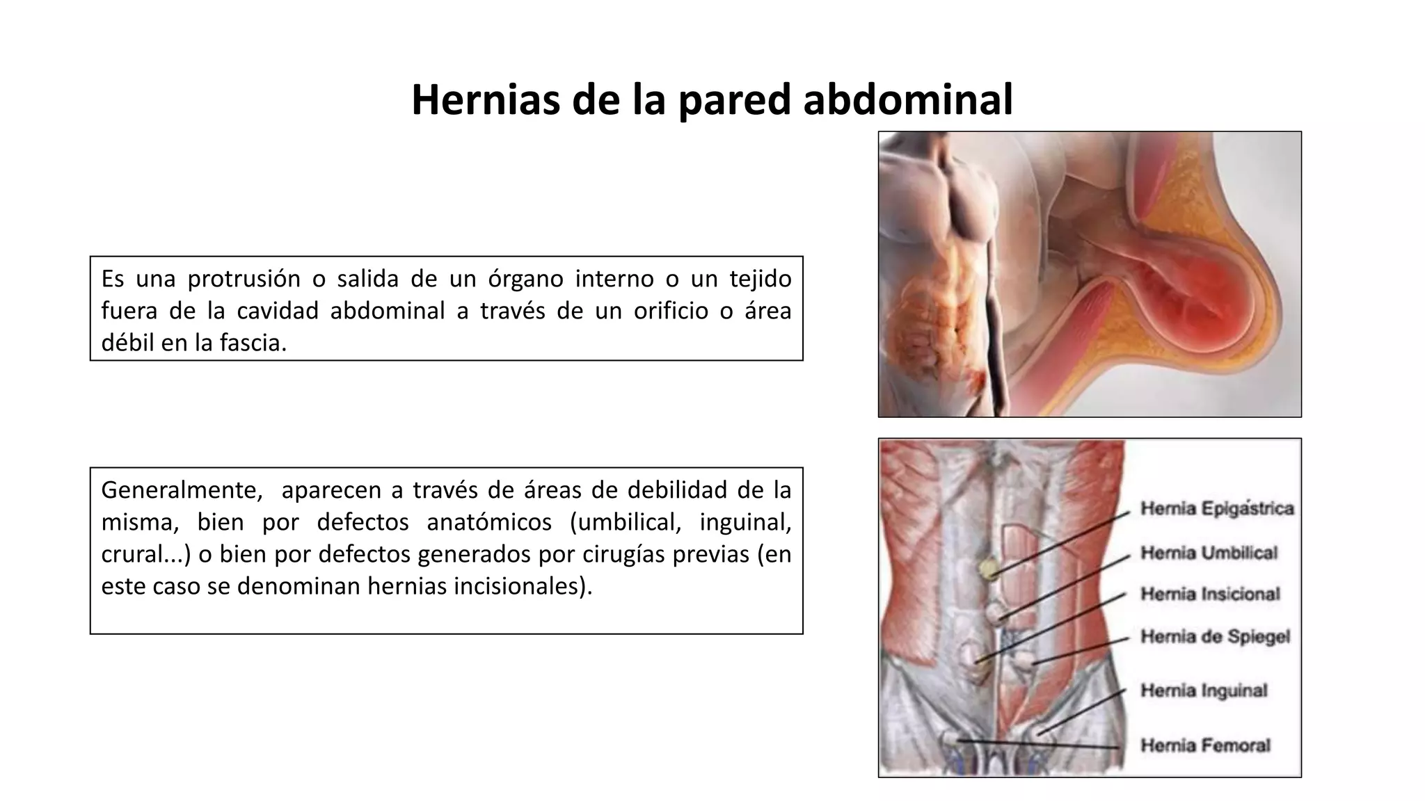 HERNIAS DE LA PARED ABDOMINAL NUEVO 2.pptx