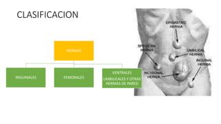 Hernias de la pared abdominal ppt karo | PPTX