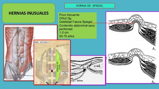 Hernias de la pared anterior y lateral del abdomen