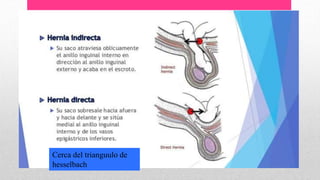 Cerca del trianguulo de
hesselbach
 