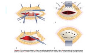 HERNIA UMBILICAL: TÉCNICAS CON TENSIÓN
TÉCNICA DE
Mayo
■ Al anudar el primer plano
quedan bordes que permiten
reingreso de vísceras.
■ Cerrar ángulos con sutura
continua.
■ Mayoríndice de recidivas.
William J. Mayo en 1901.
• Resección del saco herniario.
• Cierre del peritoneo.
• Aproximación de los bordes del
recto hacia la línea media.
• Cierre del defecto herniario.
(Borde superior sobre borde
inferior) con puntos en “U.”
 