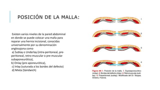 - POSICIÓN DE LA MALLA:
Existen varios niveles de la pared abdominal
en donde se puede colocar una malla para
reparar una hernia incisional, conocidas
universalmente por su denominación
anglosajona como
a) Sublay o Underlay (intra-peritoneal, pre-
peritoneal, retro-muscular o pre-muscular
subaponeurótica),
b) Onlay (pre-aponeurótica),
c) Inlay (suturada a los bordes del defecto)
d) Mixta (Sándwich)
 