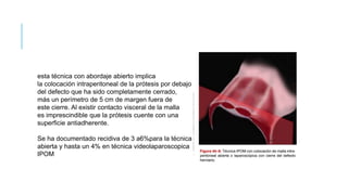 esta técnica con abordaje abierto implica
la colocación intraperitoneal de la prótesis por debajo
del defecto que ha sido completamente cerrado,
más un perímetro de 5 cm de margen fuera de
este cierre. Al existir contacto visceral de la malla
es imprescindible que la prótesis cuente con una
superficie antiadherente.
Se ha documentado recidiva de 3 a6%para la técnica
abierta y hasta un 4% en técnica videolaparoscopica
IPOM
 