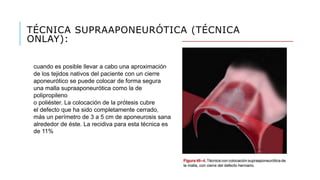 TÉCNICA SUPRAAPONEURÓTICA (TÉCNICA
ONLAY):
cuando es posible llevar a cabo una aproximación
de los tejidos nativos del paciente con un cierre
aponeurótico se puede colocar de forma segura
una malla supraaponeurótica como la de
polipropileno
o poliéster. La colocación de la prótesis cubre
el defecto que ha sido completamente cerrado,
más un perímetro de 3 a 5 cm de aponeurosis sana
alrededor de éste. La recidiva para esta técnica es
de 11%
 