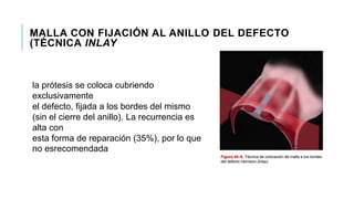 MALLA CON FIJACIÓN AL ANILLO DEL DEFECTO
(TÉCNICA INLAY
la prótesis se coloca cubriendo
exclusivamente
el defecto, fijada a los bordes del mismo
(sin el cierre del anillo). La recurrencia es
alta con
esta forma de reparación (35%), por lo que
no esrecomendada
 