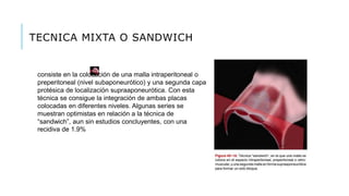 TECNICA MIXTA O SANDWICH
consiste en la colocación de una malla intraperitoneal o
preperitoneal (nivel subaponeurótico) y una segunda capa
protésica de localización supraaponeurótica. Con esta
técnica se consigue la integración de ambas placas
colocadas en diferentes niveles. Algunas series se
muestran optimistas en relación a la técnica de
“sandwich”, aun sin estudios concluyentes, con una
recidiva de 1.9%
 