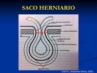SACO HERNIARIO
Snell R.; Anatomía Clínica, 2002.
 