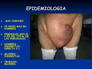 EPIDEMIOLOGIA
 MAS COMUNES
 25 VECES MAS EN
HOMBRES
 FEMORALES SON EL
2.5% DEL TOTAL DE
LAS INGUINALES
 HOMBRES :
INDIRECTAS :
DIRECTA 2:1
 MUJERES :
INDIRECTAS
 CRURALES:
MUJERES
 