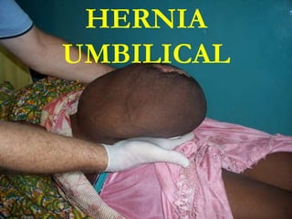 HERNIA
UMBILICAL
 