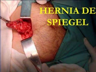 HERNIA DE
SPIEGEL
 