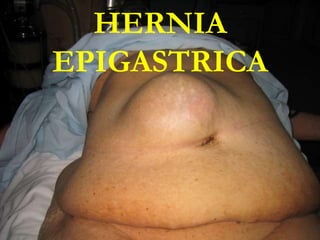 HERNIA
EPIGASTRICA
 