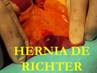 HERNIA DE
RICHTER
 