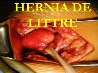 HERNIA DE
LITTRE
 