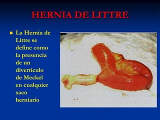 HERNIA DE LITTRE
 La Hernia de
Littre se
define como
la presencia
de un
divertículo
de Meckel
en cualquier
saco
herniario
 