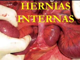 HERNIAS
INTERNAS
 