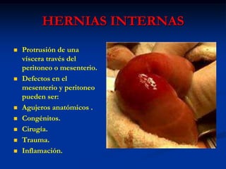 HERNIAS INTERNAS
 Protrusión de una
víscera través del
peritoneo o mesenterio.
 Defectos en el
mesenterio y peritoneo
pueden ser:
 Agujeros anatómicos .
 Congénitos.
 Cirugía.
 Trauma.
 Inflamación.
 