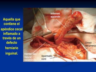 Aquella que
contiene el
apéndice cecal
inflamado a
través de un
defecto
herniario
inguinal.
 