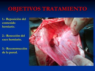 OBJETIVOS TRATAMIENTO
1.- Reposición del
contenido
herniario.
2.- Resección del
saco herniario.
3.- Reconstrucción
de la pared.
 