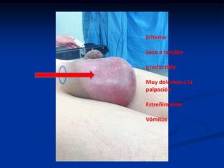 Eritema
Saco a tensión
Irreductible
Muy doloroso a la
palpación
Estreñimiento
Vómitos
 