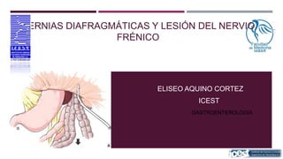 HERNIAS DIAFRAGMÁTICAS Y LESIÓN DEL NERVIO
FRÉNICO

ELISEO AQUINO CORTEZ
ICEST
GASTROENTEROLOGIA

 