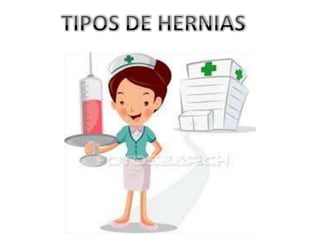 TIPOS DE HERNIAS
