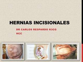 HERNIAS INCISIONALES
  DR CARLOS RESPARDO R3CG
  HCC
 
