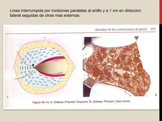 Linea interrumpida por incisiones paralelas al anillo y a 1 cm en direccion
lateral seguidas de otras mas externas
 