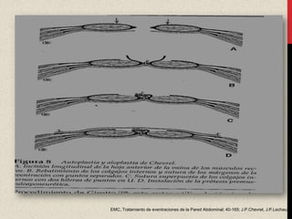 EMC, Tratamiento de eventraciones de la Pared Abdominal; 40-165; J.P.Chevrel, J.P.Lechaux
 