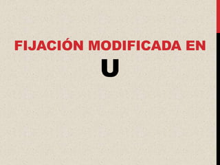 FIJACIÓN MODIFICADA EN
         U
 