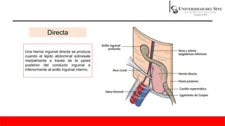 Directa
Una hernia inguinal directa se produce
cuando el tejido abdominal sobresale
medialmente a través de la pared
posterior del conducto inguinal e
inferiormente al anillo inguinal interno.
 