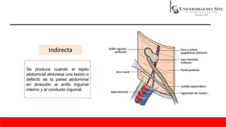 Indirecta
Se produce cuando el tejido
abdominal atraviesa una lesión o
defecto de la pared abdominal
en dirección al anillo inguinal
interno y al conducto inguinal.
 