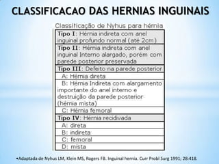 CLASSIFICACAO DAS HERNIAS INGUINAIS




•Adaptada de Nyhus LM, Klein MS, Rogers FB. Inguinal hernia. Curr Probl Surg 1991; 28:418.
 