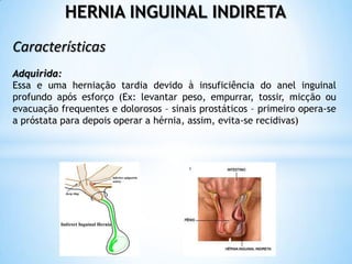 HERNIA INGUINAL INDIRETA
Características
Adquirida:
Essa e uma herniação tardia devido à insuficiência do anel inguinal
profundo após esforço (Ex: levantar peso, empurrar, tossir, micção ou
evacuação frequentes e dolorosos – sinais prostáticos – primeiro opera-se
a próstata para depois operar a hérnia, assim, evita-se recidivas)
 