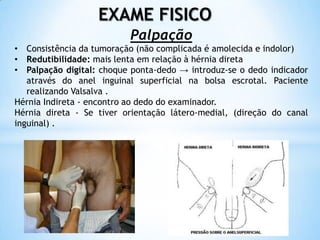 EXAME FISICO
                          Palpação
• Consistência da tumoração (não complicada é amolecida e indolor)
• Redutibilidade: mais lenta em relação à hérnia direta
• Palpação digital: choque ponta-dedo → introduz-se o dedo indicador
   através do anel inguinal superficial na bolsa escrotal. Paciente
   realizando Valsalva .
Hérnia Indireta - encontro ao dedo do examinador.
Hérnia direta - Se tiver orientação látero-medial, (direção do canal
inguinal) .
 