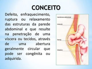 CONCEITO
Defeito, enfraquecimento,
ruptura ou relaxamento
das estruturas da parede
abdominal e que resulte
na penetração de uma
víscera ou tecidos, através
de      uma       abertura
geralmente circular que
pode ser congênita ou
adquirida.
 