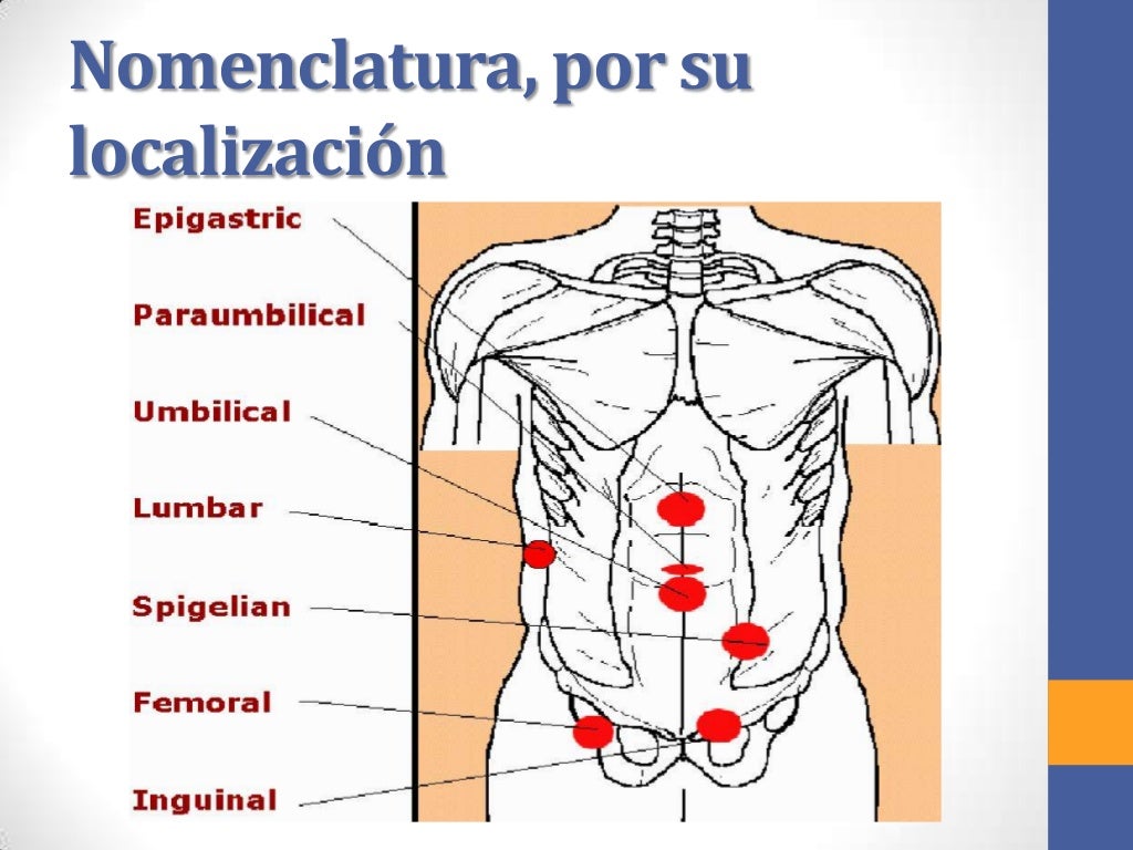 Hernias inguinales