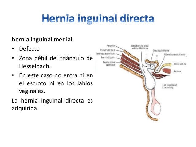 Hernias inguinales directas e indirectas pdf