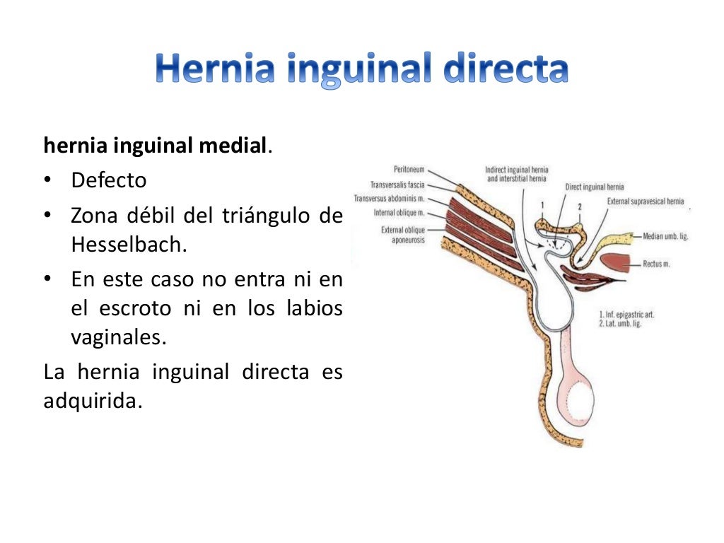 Hernias inguinales