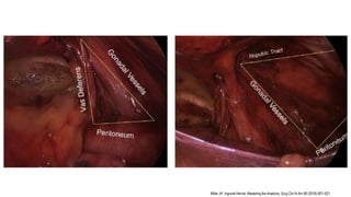 Miller JH. Inguinal Hernia: Mastering the Anatomy. Surg Clin N Am 98 (2018) 607–621.
 