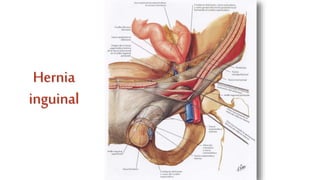Hernia
inguinal
 