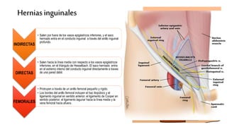Herniasinguinales
INDIRECTAS
• Salen por fuera de los vasos epigástricos inferiores, y el saco
herniado entra en el conducto inguinal a través del anillo inguinal
profundo.
DIRECTAS
• Salen hacia la línea media con respecto a los vasos epigástricos
inferiores, en el triángulo de Hesselbach. El saco herniado entra
en el extremo interno del conducto inguinal directamente a traves
de una pared débil.
FEMORALES
• Protruyen a través de un anillo femoral pequeño y rígido.
• Los bordes del anillo femoral incluyen el haz iliopúbico y el
ligamento inguinal en sentido anterior, el ligamento de Cooper en
sentido posterior, el ligamento lagunar hacia la línea media y la
vena femoral hacia afuera.
Más frecuente en hombres
Mecanismo de producción:
 Congénitas
 Proceso vaginal parcial o total permeable
 Saco peritoneal entra al canal inguinal
por el anillo inguinal profundo
Mecanismo de producción:
Adquirida
Sale directamente del anillo inguinal
profundo en el ▲ H
Más frecuente en Hombres mayores
 