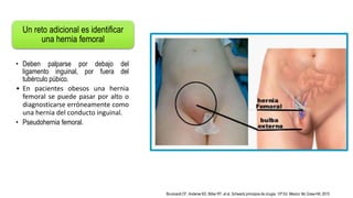 Un reto adicional es identificar
una hernia femoral
• Deben palparse por debajo del
ligamento inguinal, por fuera del
tubérculo púbico.
• En pacientes obesos una hernia
femoral se puede pasar por alto o
diagnosticarse erróneamente como
una hernia del conducto inguinal.
• Pseudohernia femoral.
Brunicardi CF, Anderse KD, Billiar RT, et al. Schwartz principios de cirugía. 10ª Ed. México: Mc Graw-Hill; 2015
 