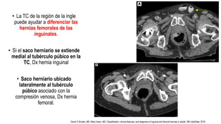 • La TC de la región de la ingle
puede ayudar a diferenciar las
hernias femorales de las
inguinales.
• Si el saco herniario se extiende
medial al tubérculo púbico en la
TC, Dx hernia inguinal
• Saco herniario ubicado
lateralmente al tubérculo
púbico asociado con la
compresión venosa, Dx hernia
femoral.
David C Brooks, MD, Mary Hawn, MD. Classification, clinical features, and diagnosis of inguinal and femoral hernias in adults. WK UptoDate, 2018.
 