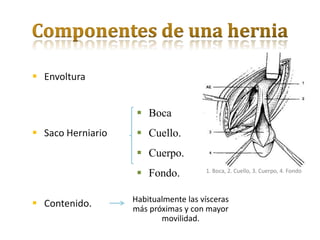  Envoltura


                     Boca
 Saco Herniario     Cuello.
                     Cuerpo.
                     Fondo.          1. Boca, 2. Cuello, 3. Cuerpo, 4. Fondo



                   Habitualmente las vísceras
 Contenido.       más próximas y con mayor
                          movilidad.
 