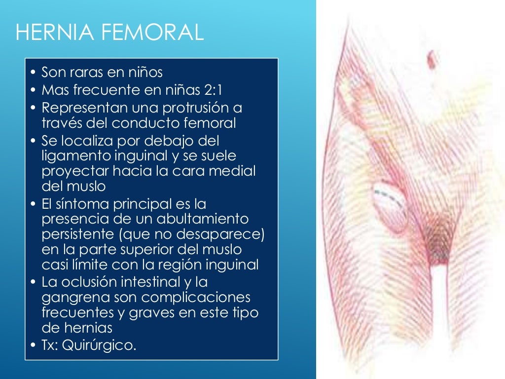 Hernias inguinales y torsion testicular