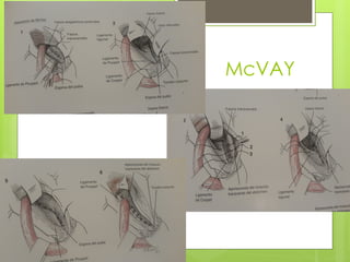 Mcvay Incision HERNIAS de la region INGUINO - FEMORALES.pptx
