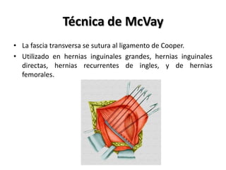 Mcvay Incision Hernias | PPTX