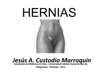 HERNIAS


Jesús A. Custodio Marroquín
Estudiante de Medicina IX Ciclo – Universidad Católica Santo Toribio de
                    Mogrovejo – Chiclayo - Perú
 